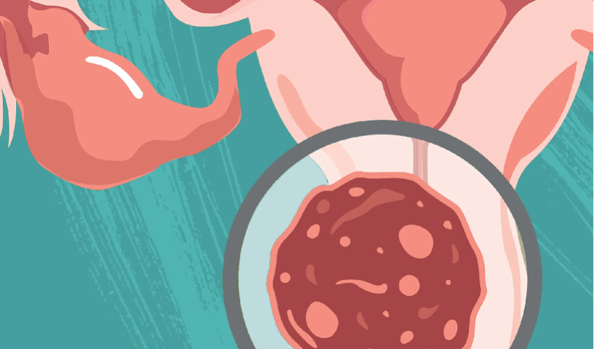 What can you do to prevent gynecologic cancer?
